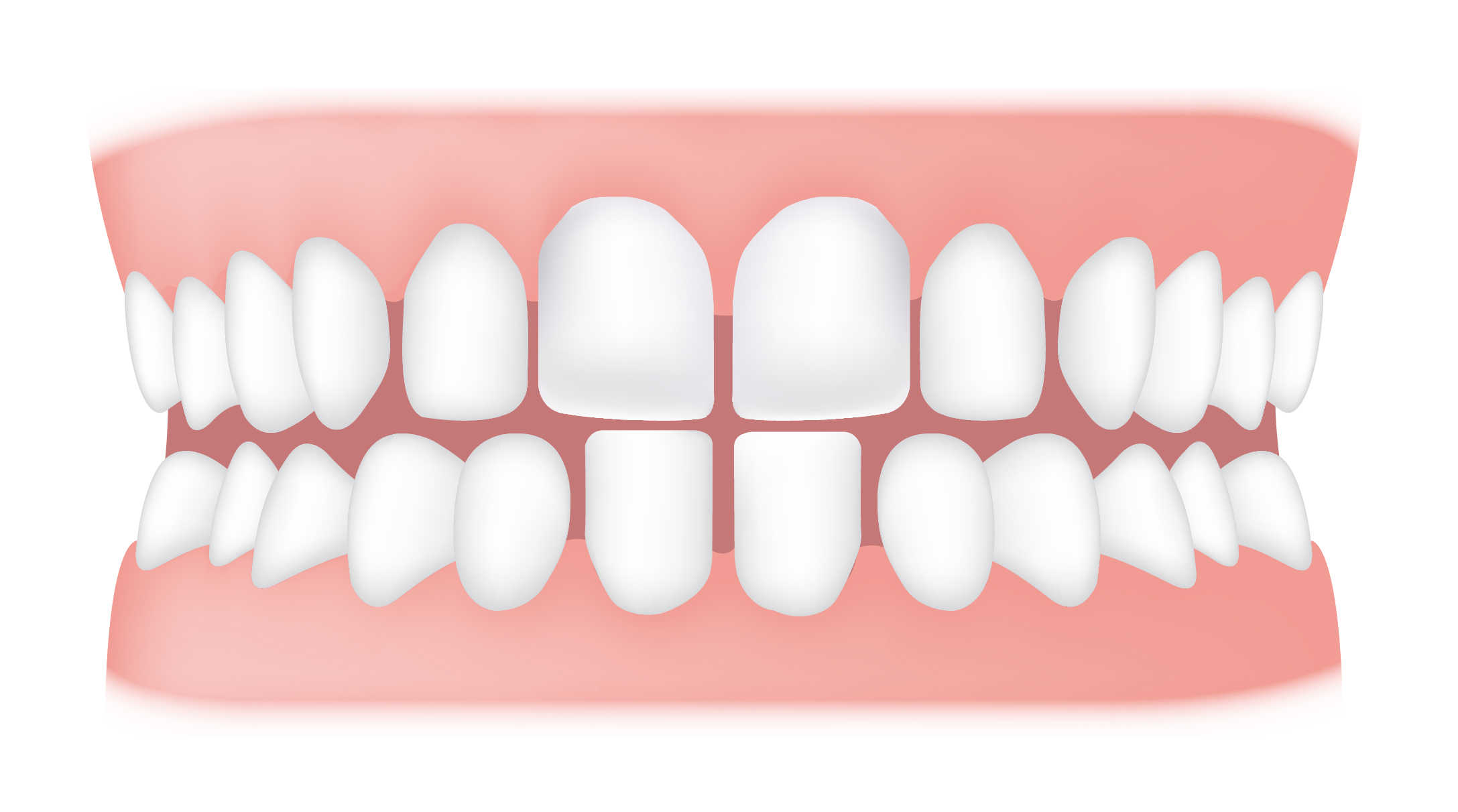 Spacing between tooth