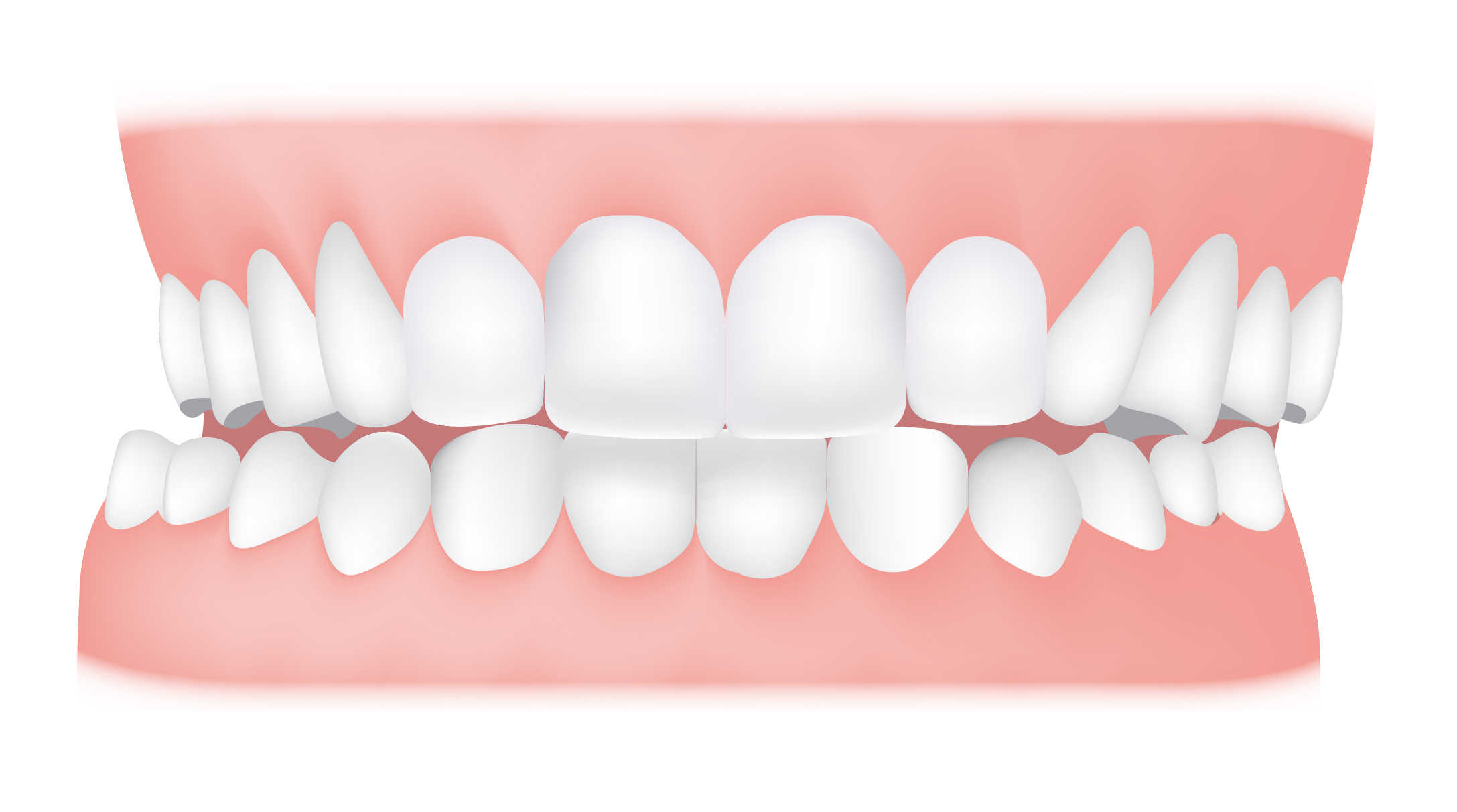 Crossbite