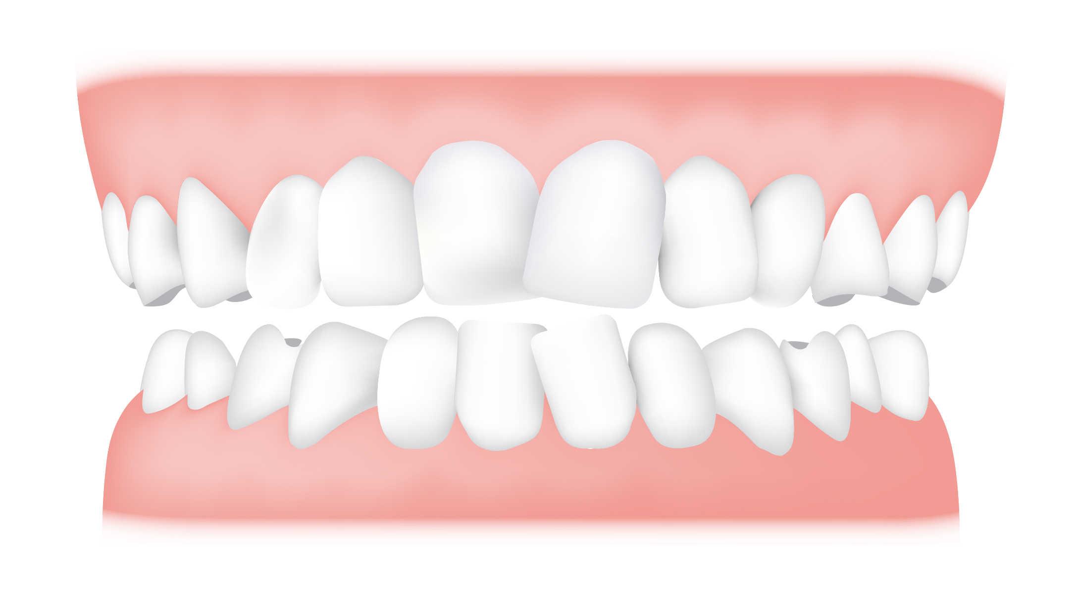 Teeth Crowding