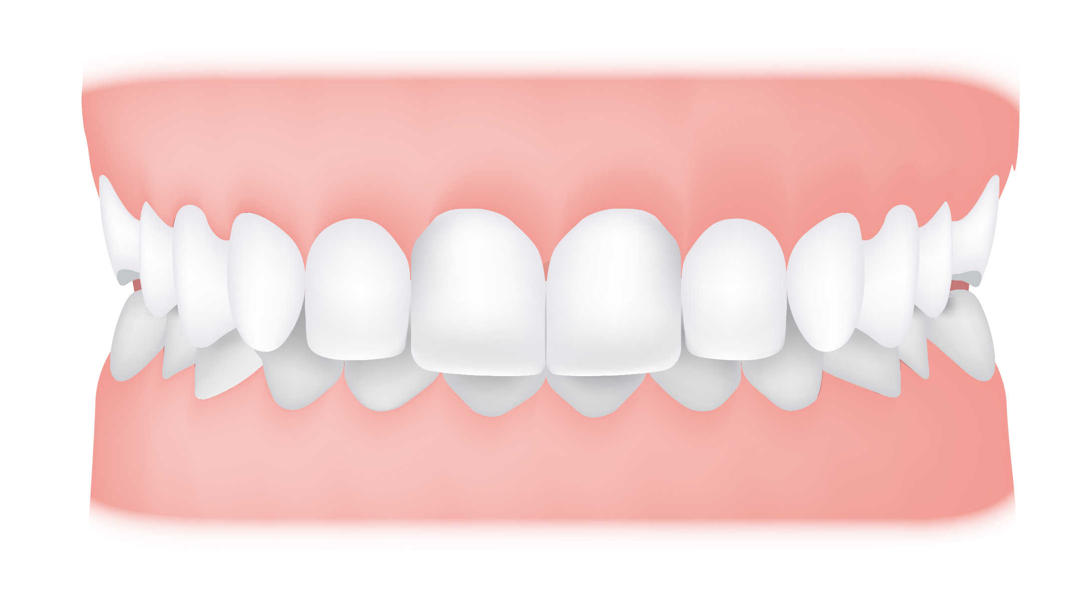 Overbite