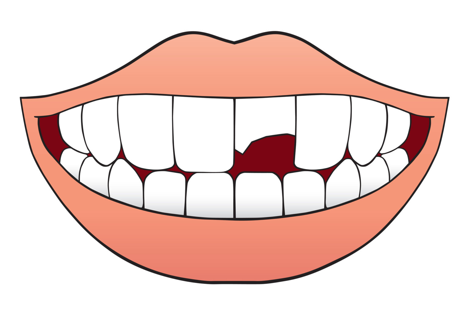 How to Fix Broken Teeth