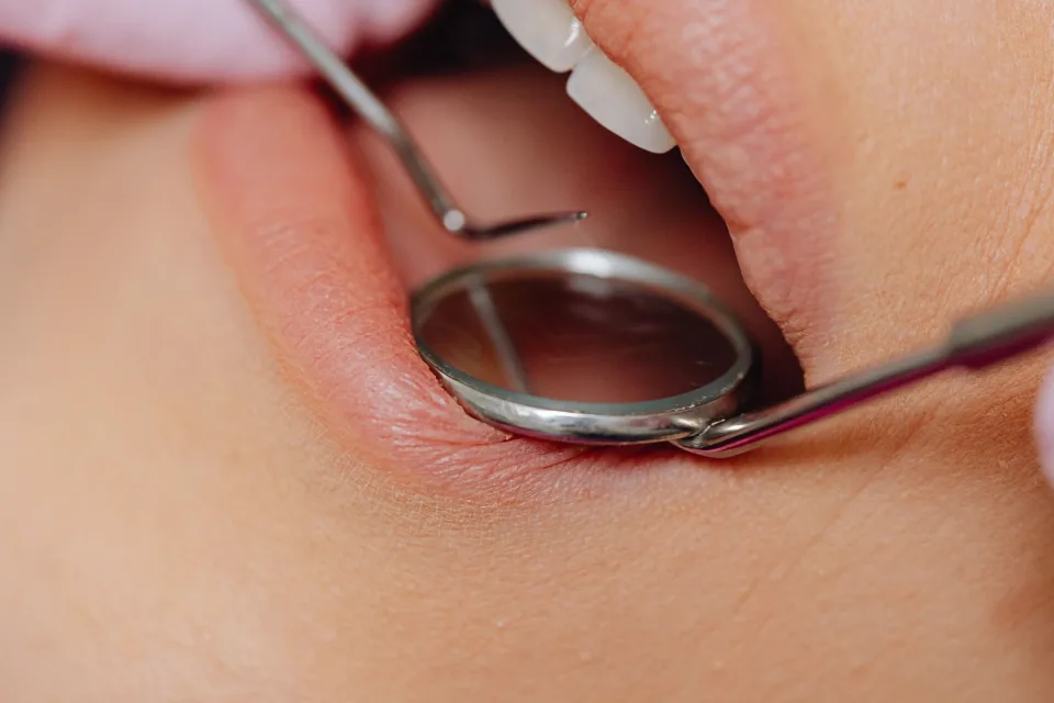 Close-up dental examination with a mouth mirror