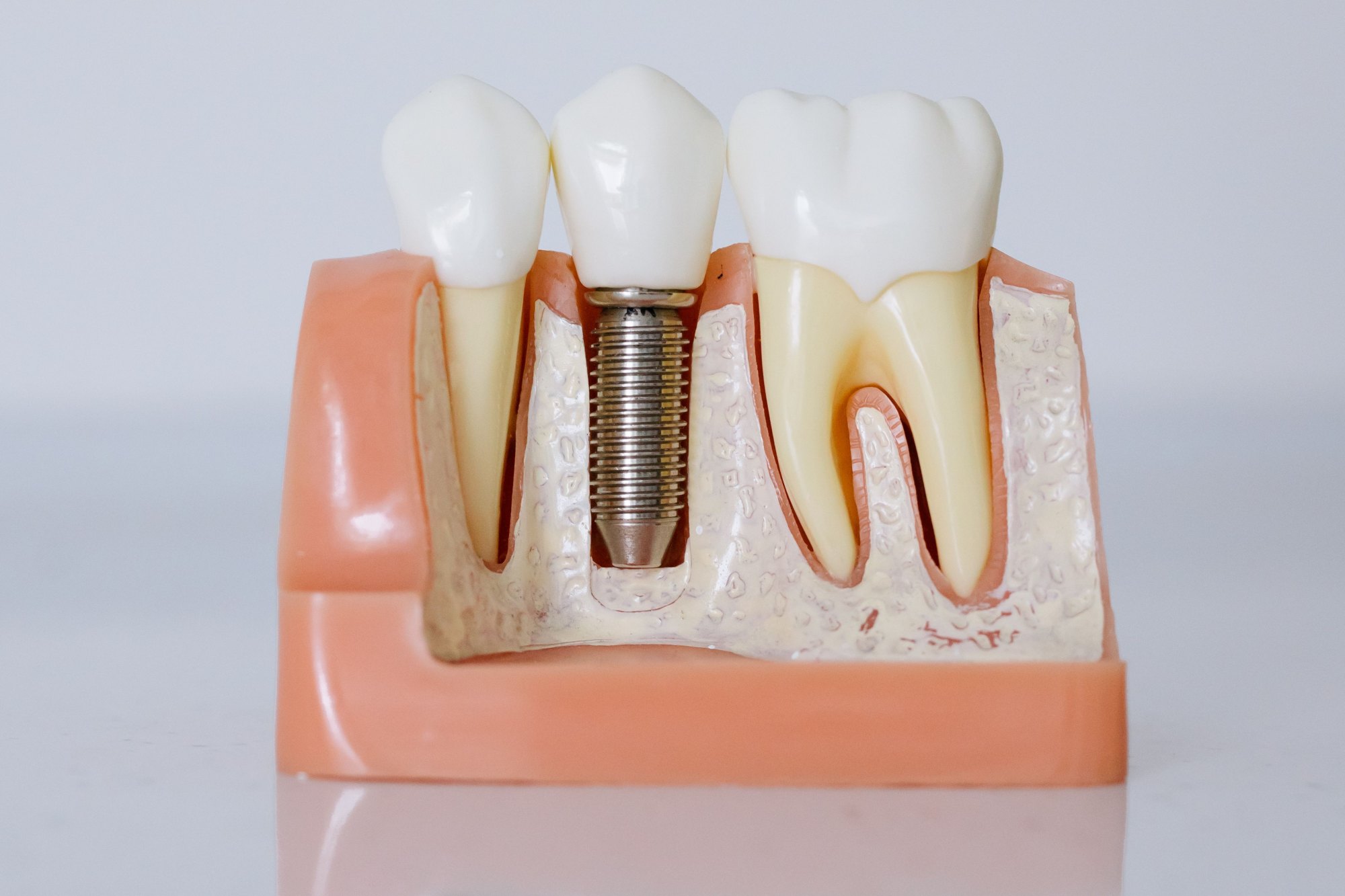 Detailed view of a dental implant model showcasing teeth and gum anatomy for dental education.