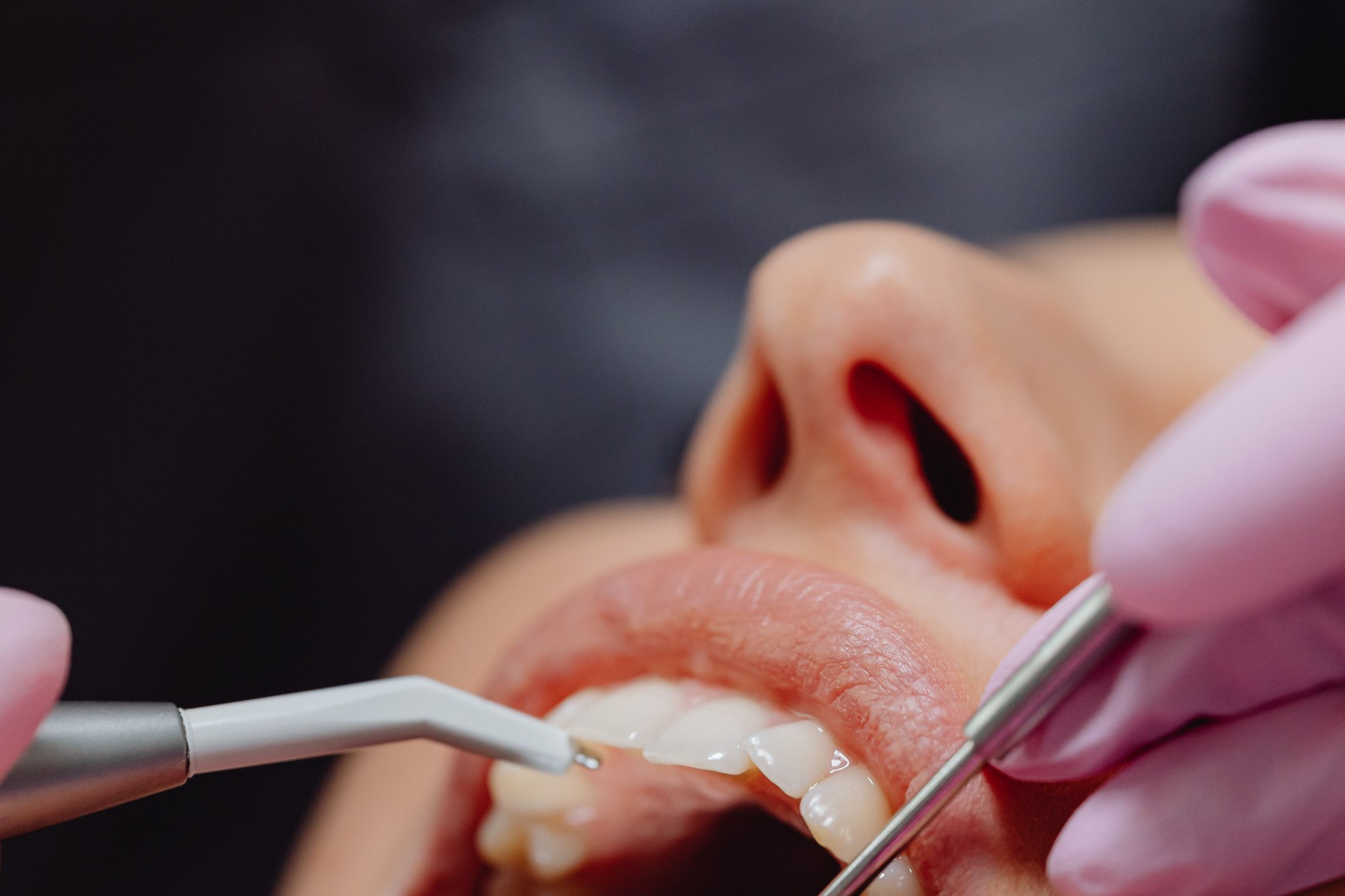 Close-up of dental procedure highlighting hygiene and patient care.